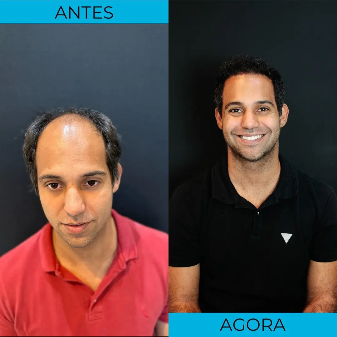 Antes e depois de transplante capilar - paciente 1