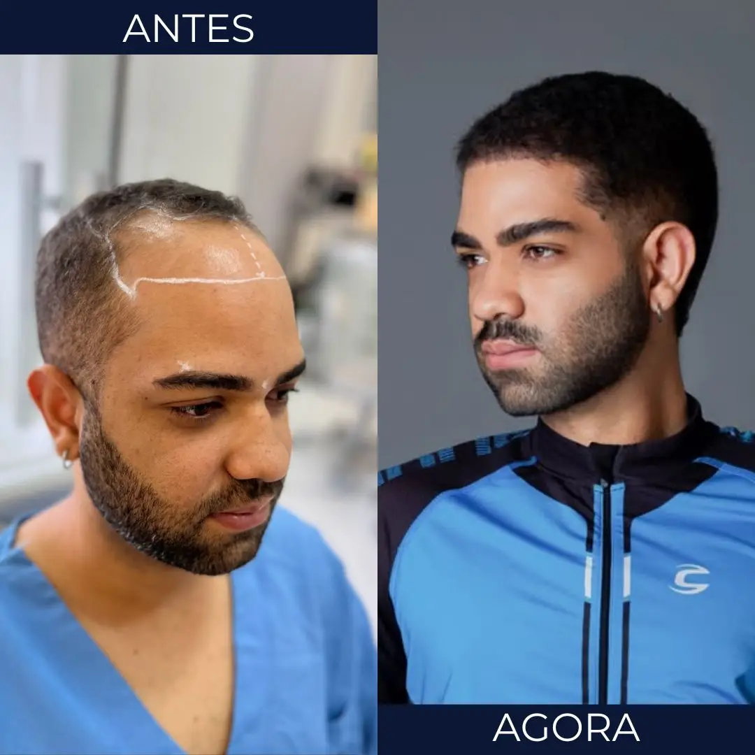 Antes e depois de transplante capilar - paciente 2