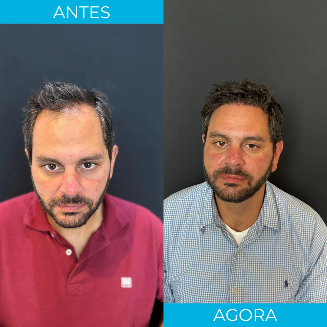 Antes e depois de transplante capilar - paciente 3