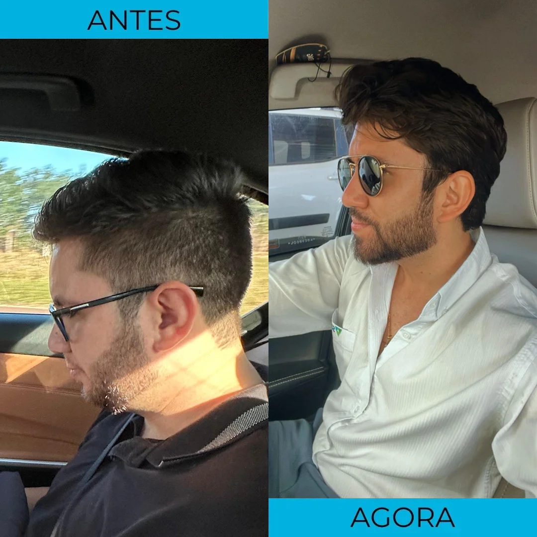 Antes e depois de transplante capilar - paciente 12