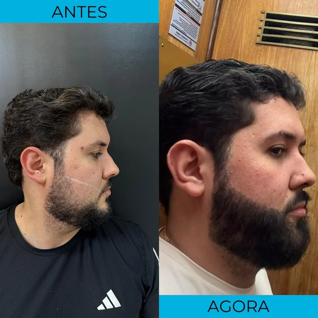 Antes e depois de transplante capilar - paciente 13