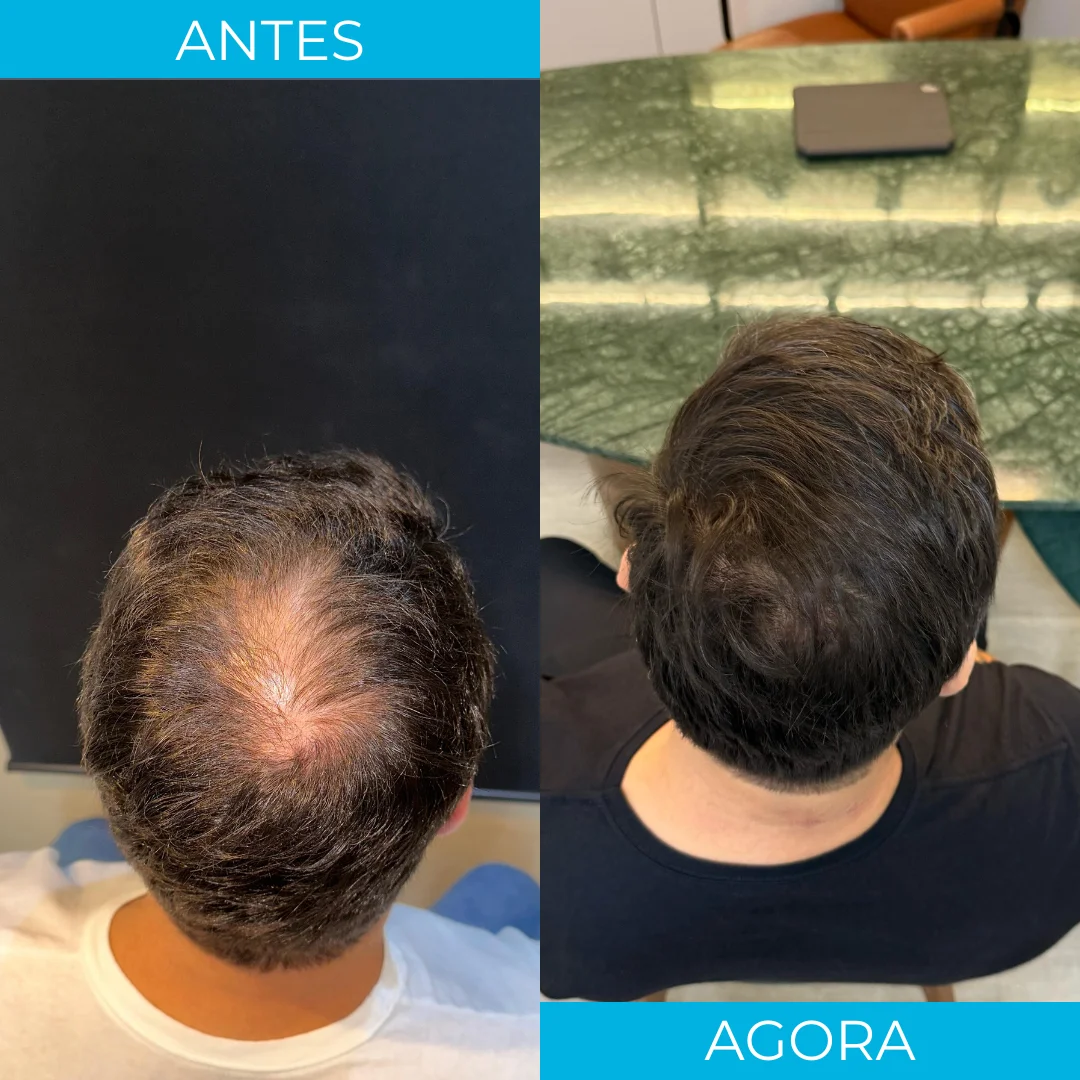 Antes e depois de transplante capilar - paciente 4