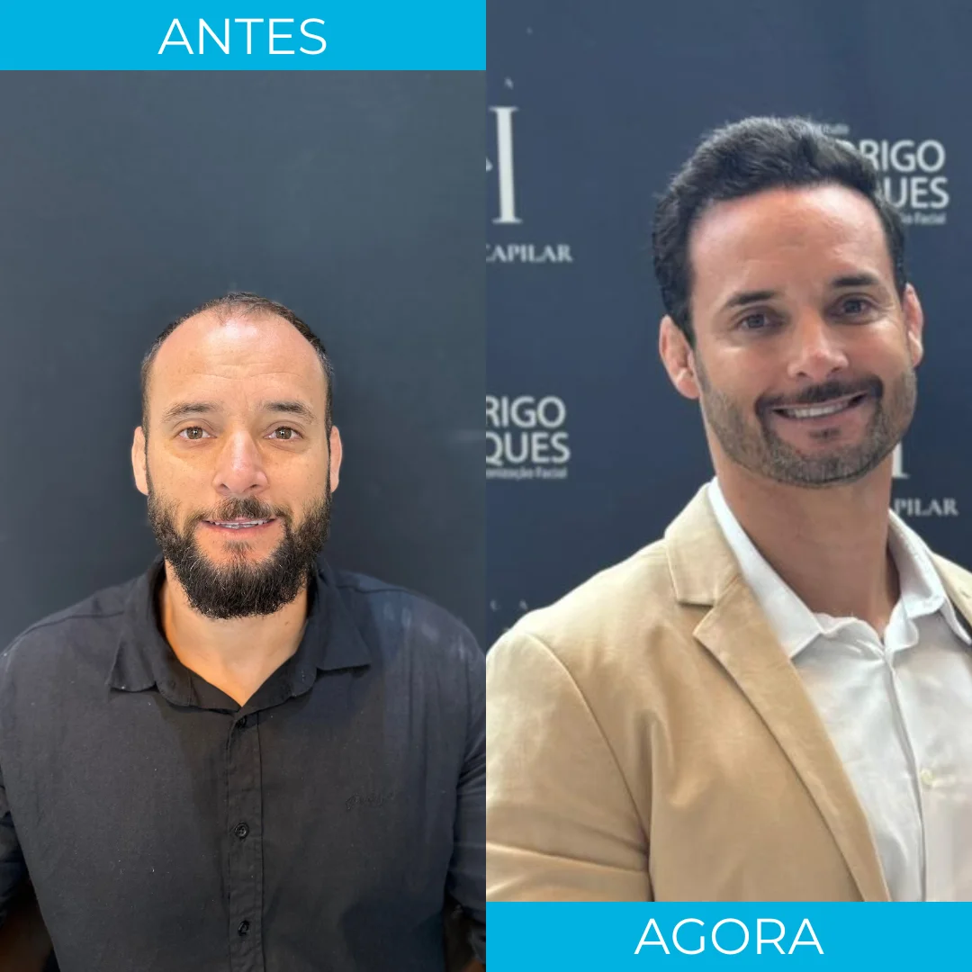 Antes e depois de transplante capilar - paciente 5