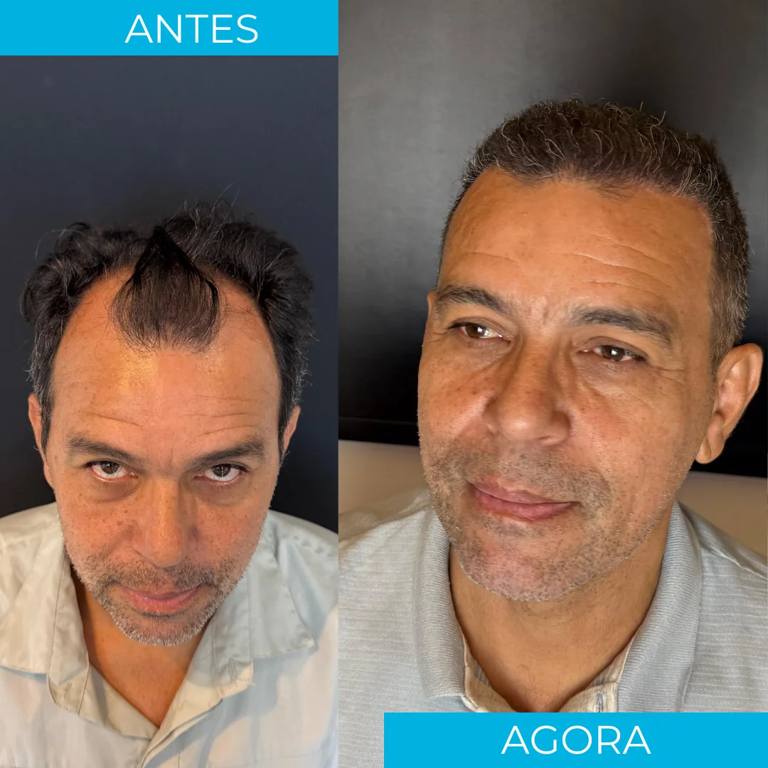 Antes e depois de transplante capilar - paciente 6