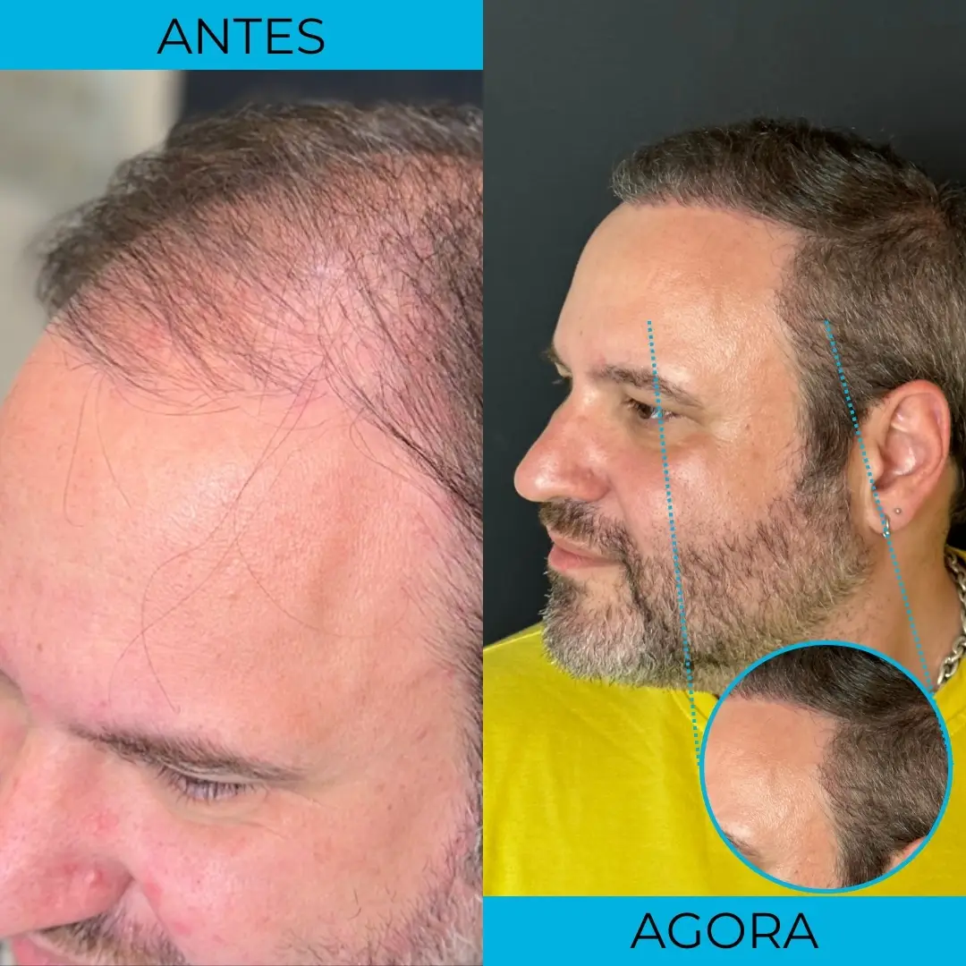 Antes e depois de transplante capilar - paciente 7