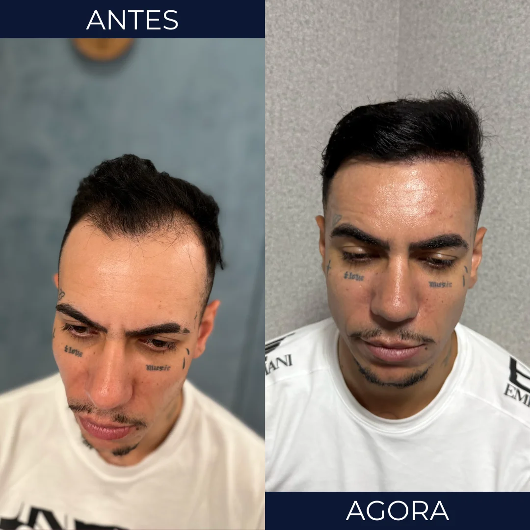 Antes e depois de transplante capilar - paciente 8
