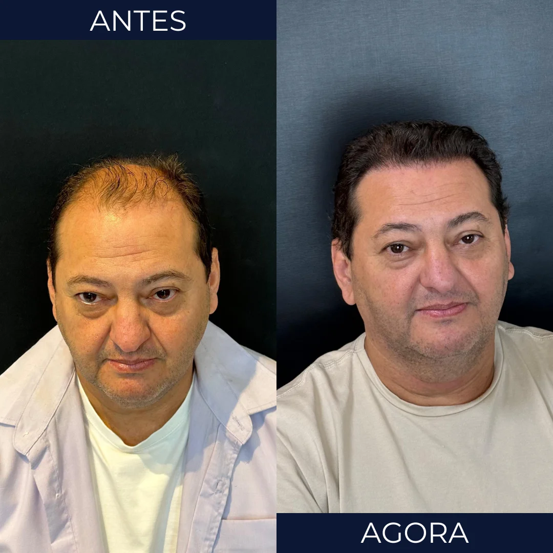 Antes e depois de transplante capilar - paciente 9