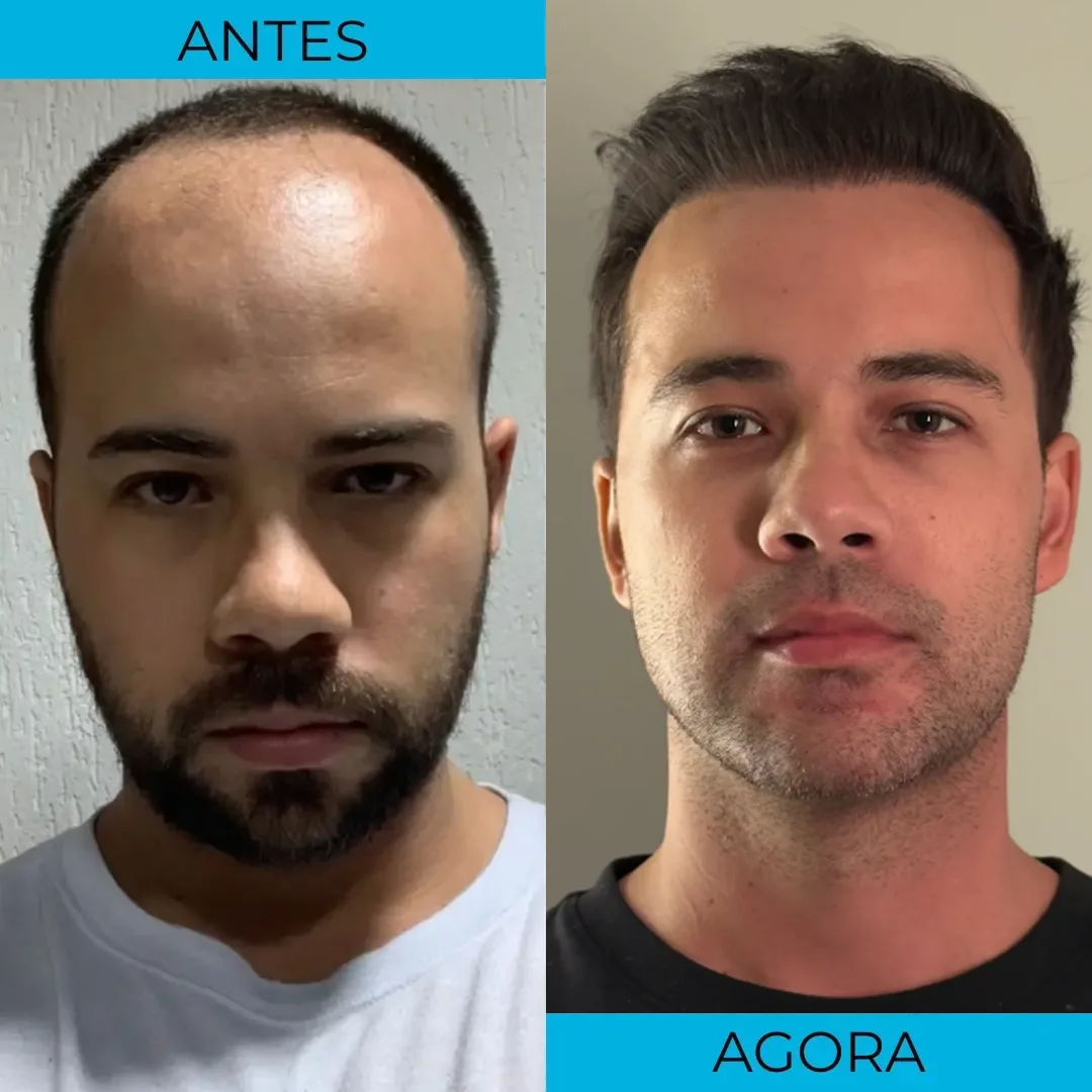 Antes e depois de transplante capilar - paciente 10