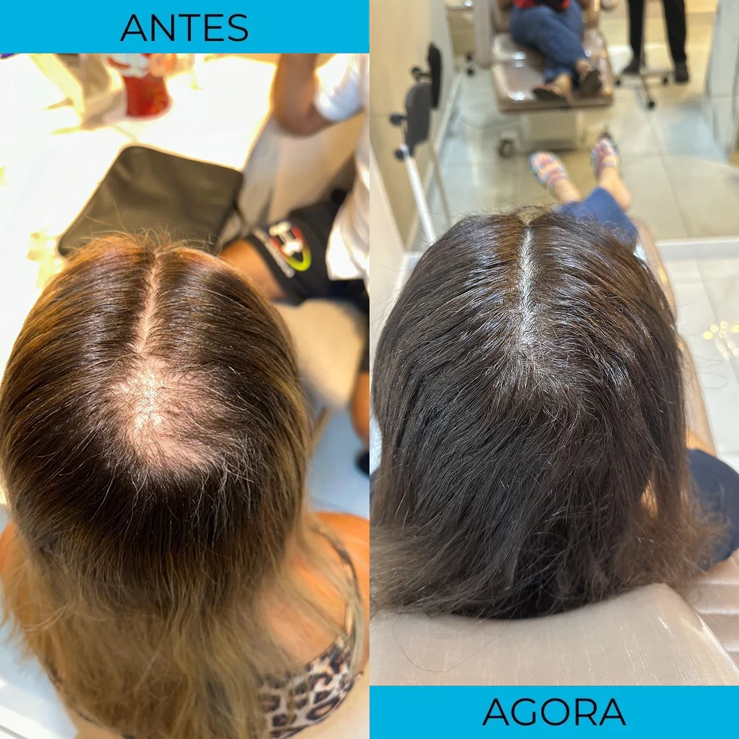 Antes e depois de transplante capilar - paciente 11